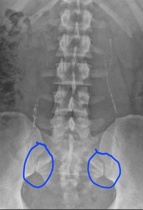 Is it hip impingement? : r/HipImpingement