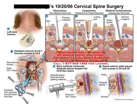 Cervical Spine Surgery