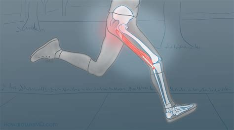 Proximal hamstring tendinopathy- a true pain in the butt