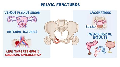 Pelvic fractures: Clinical sciences - Osmosis Video Library