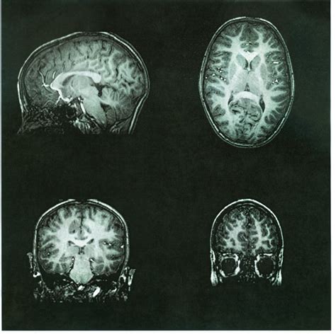 Researchers develop two methods to treat seizures in Dravet syndrome ...