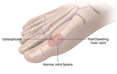 BioPro Hemi Toe Implant for Hallux Rigidus (2022)