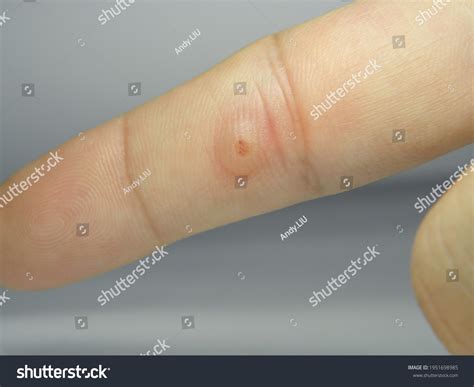 Viral Warts Cryotherapy Blisters On First Foto Stok 1951698985 | Shutterstock