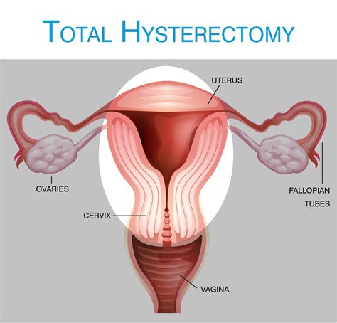 What is a hysterectomy?