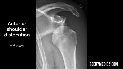 Shoulder X-ray Interpretation | Radiology | Geeky Medics