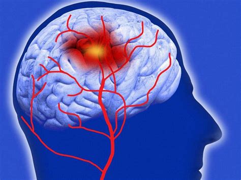 Cerebrovascular Accident: What Is Cerebrovascular Accident?