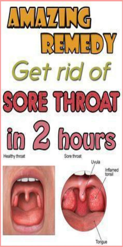 Home Remedies For Sore Throat | Wellness Treats