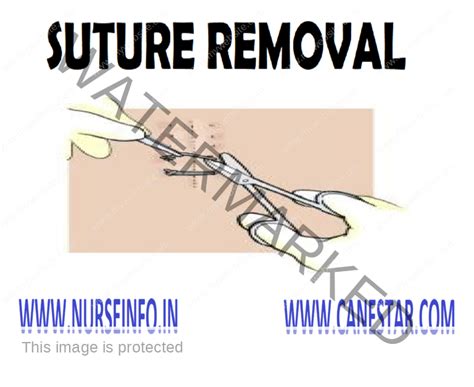 SUTURE REMOVAL - Nurse Info