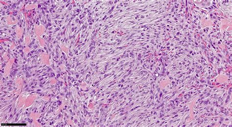 Morpheaform Basal Cell Carcinoma Histology