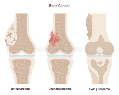 Bone Cancer Types Set. Ewing S Sarcoma, Osteosarcoma and Chondrosarcoma Stock Vector ...