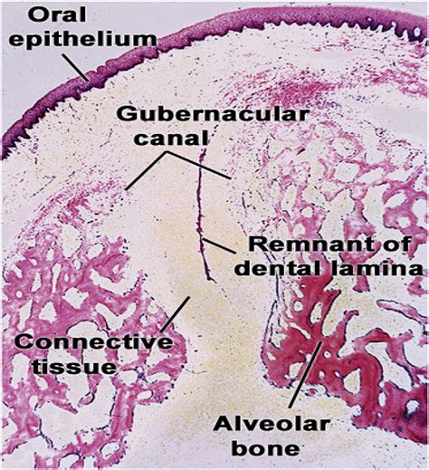 Photomicrograph showing gubernacular canal and cord [4]. | Download Scientific Diagram