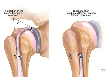 My Shoulder Superior Labrum is Torn: Do I Need Surgery? - Shoulder & Elbow