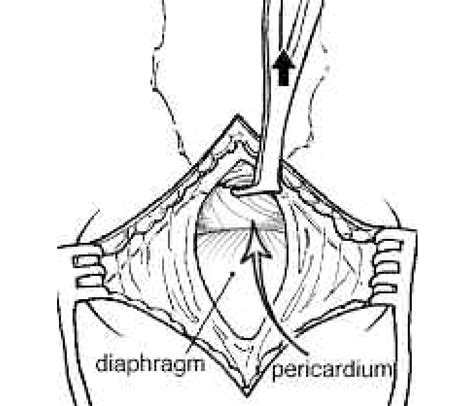 Subxiphoid Pericardial Window