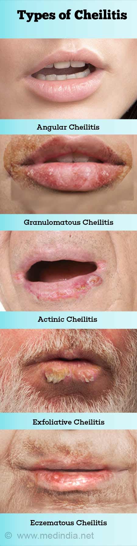 Cheilitis Granulomatosa