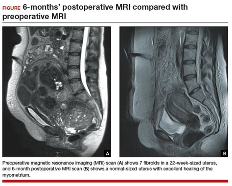 7 Myomectomy myths debunked | MDedge ObGyn