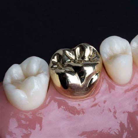 Full Gold Crowns | DMS Dentistry