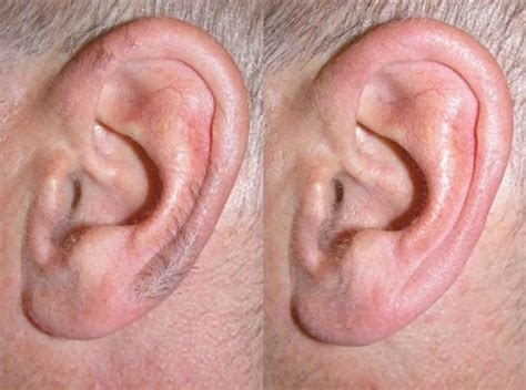 Ear hair function & ear hair removal techniques