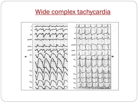 PPT - WIDE QRS TACHYCARDIA PowerPoint Presentation, free download - ID:1016818