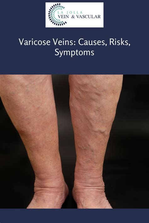 Vein & Vascular Treatment | Varicose Veins