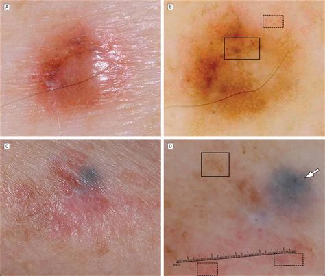 Clinical and Dermoscopic Characteristics of Desmoplastic Melanomas | Dermatology | JAMA ...