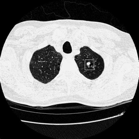 Lung Cancer Deaths Reduced by CT Scans, Study Finds - The New York Times