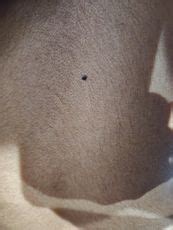 Mole updated mole biopsy results | BabyCenter