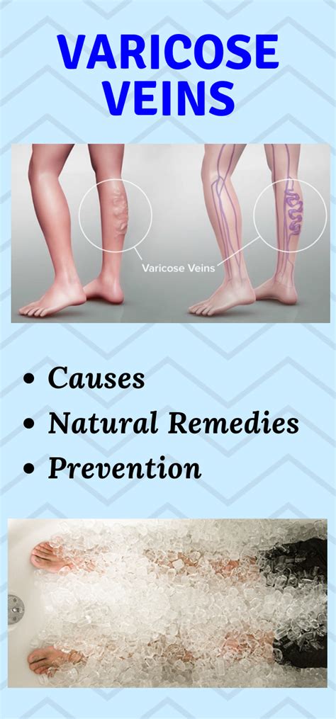 Natural Health Advice: Varicose Veins: Causes, Natural Remedies and ...