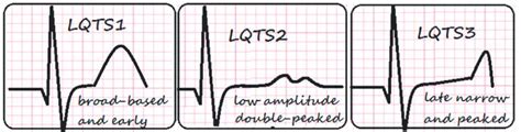 T-wave morphology in different sybtypes of congenital LQTS | Download ...