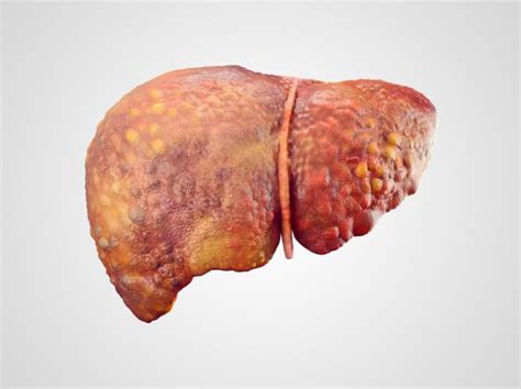 Liver cancer risk lingers after hepatitis B virus cleared