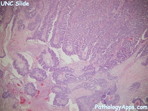 endometrial serous carcinoma pathology