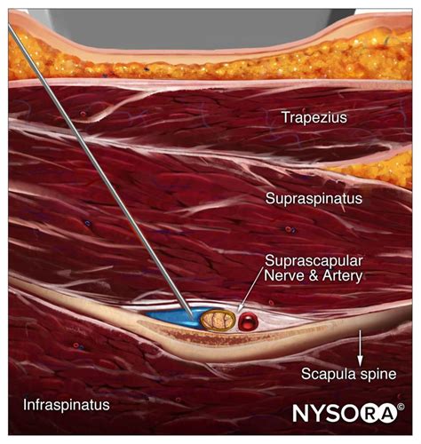 Ultrasound Pain Block Tip of the Week: Suprascapular Nerve Block - NYSORA | NYSORA