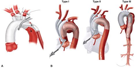 Technical aspects of surgical reconstruction for total aortic arch... | Download Scientific Diagram