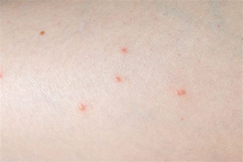 What Spider Bites Look Like—and When to Call the Doctor | RD.ca