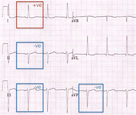 Right Axis Deviation Ecg - Simple Education / The mean qrs axis during ...