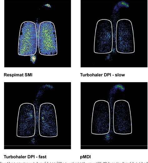 Figure 4 from Use of Respimat® Soft Mist™ Inhaler in COPD patients ...