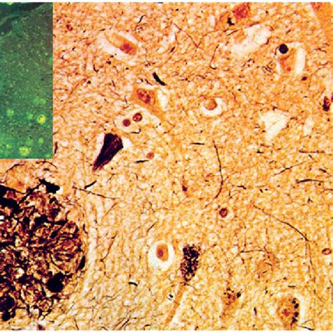 Histological lesions in Alzheimer's disease. Neurofibrillary tangles,... | Download Scientific ...