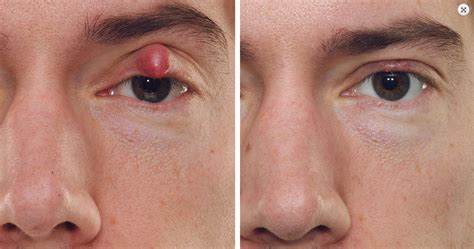 Before & After: Eye Cysts #beforeandafter #cosmeticsurgery #laser # ...