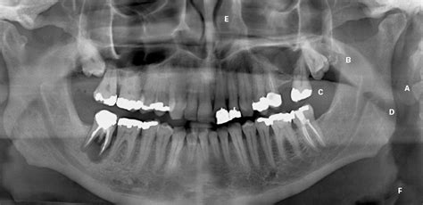 RACGP - Interpreting an orthopantomogram