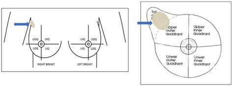 Breast Pain, Palpable Mass, and a Perplexing Diagnosis | ACS