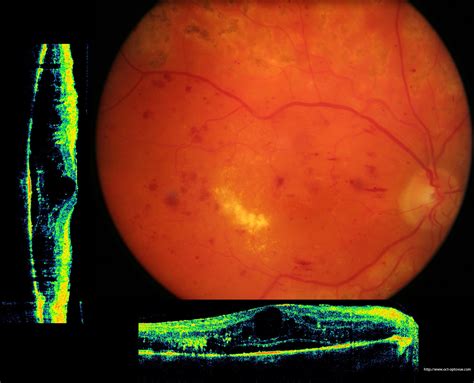 Retinopathy: Oct In Diabetic Retinopathy