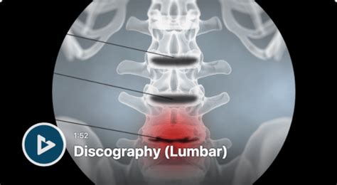 Lumbar Discogram / Cervical Discogram - Pain Management Physicians of South Florida