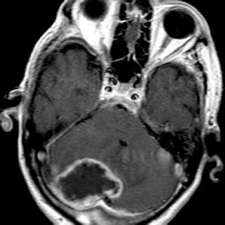 MRI of brain showing a lesion in the right cerebellar hemisphere, T1... | Download Scientific ...