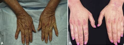 Dermatomyositis: Clinical features and pathogenesis - Journal of the American Academy of Dermatology