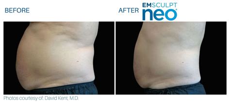 Emsculpt NEO Before and After | Real Patient Results