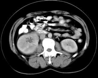 Acute Pyelonephritis - Sumer's Radiology Blog