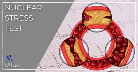 Nuclear Stress Test (Myocardial Perfusion Imaging) Demystified