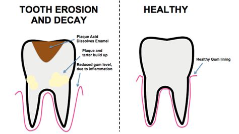 Rotten Teeth and Its Symptoms - College Plaza Dental Associates