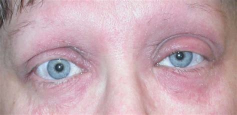 Eyelid dermatitis causes, symptoms, diagnosis & treatment