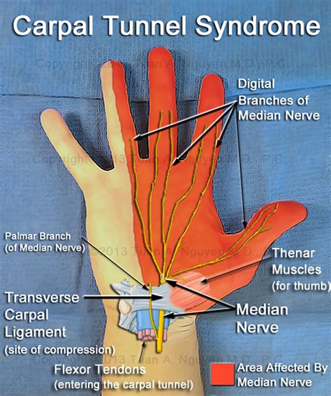 Symptoms of carpal tunnel - virtfact