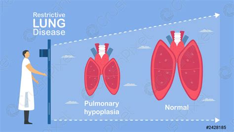 Lung Hypoplasia